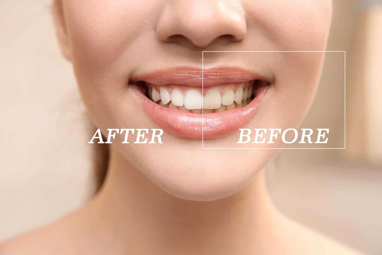How Can You Maintain a Consistent Smile Shade with Crowns Henley?