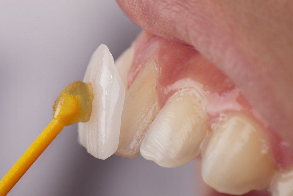 Dental Veneers: Achieving a Flawless Look Henley