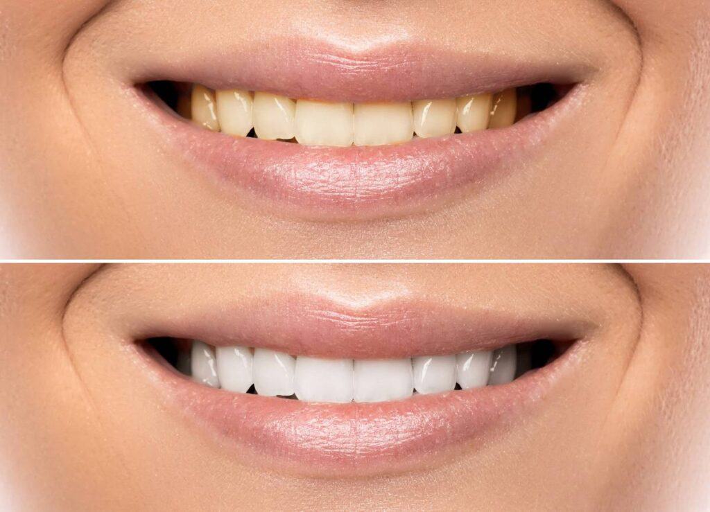 How Does Gum Disease Progress if Left Untreated Henley?