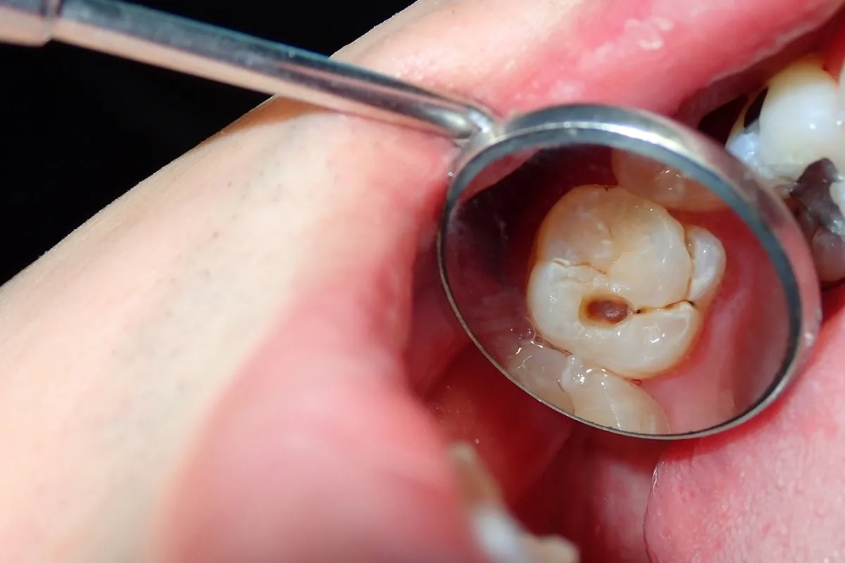 Why Do Teeth Crack? Common Causes to Know Henley