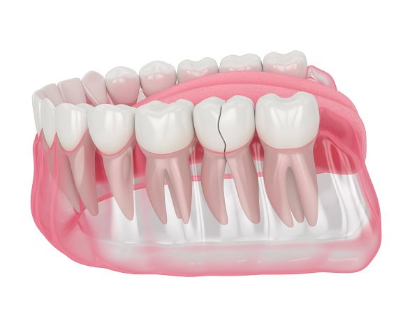How Can You Manage Pain and Discomfort After a Root Canal Henley?