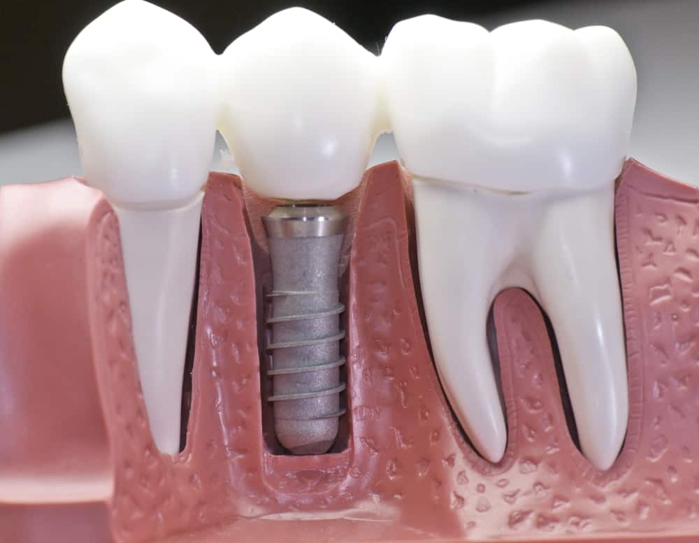 Who Is a Good Candidate for Dental Implants Henley?