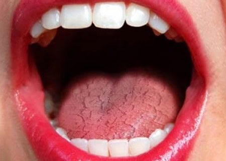 Common Causes of Dry Mouth (Xerostomia) Henley
