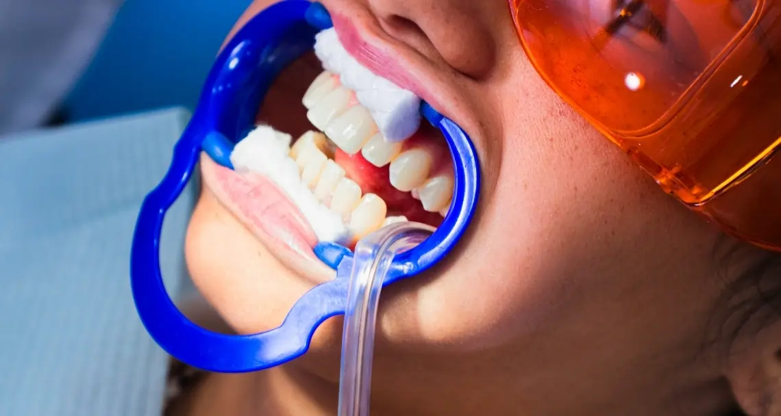 How Teeth Whitening Treatments Actually Work on Your Enamel Henley