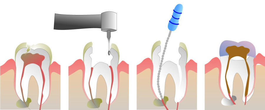 How Do You Properly Care for Your Teeth After a Root Canal Henley