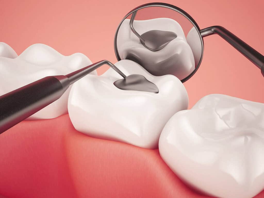 Fighting Cavities and Plaque Buildup Henley