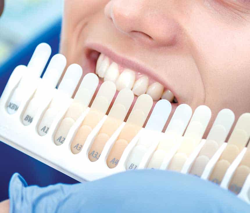 Professional vs At-Home Whitening: What You Need to Know Henley