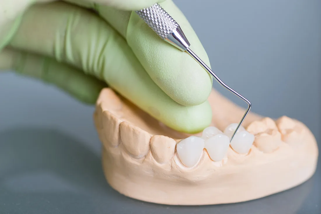 What Are the Different Types of Dental Crowns Available Henley?