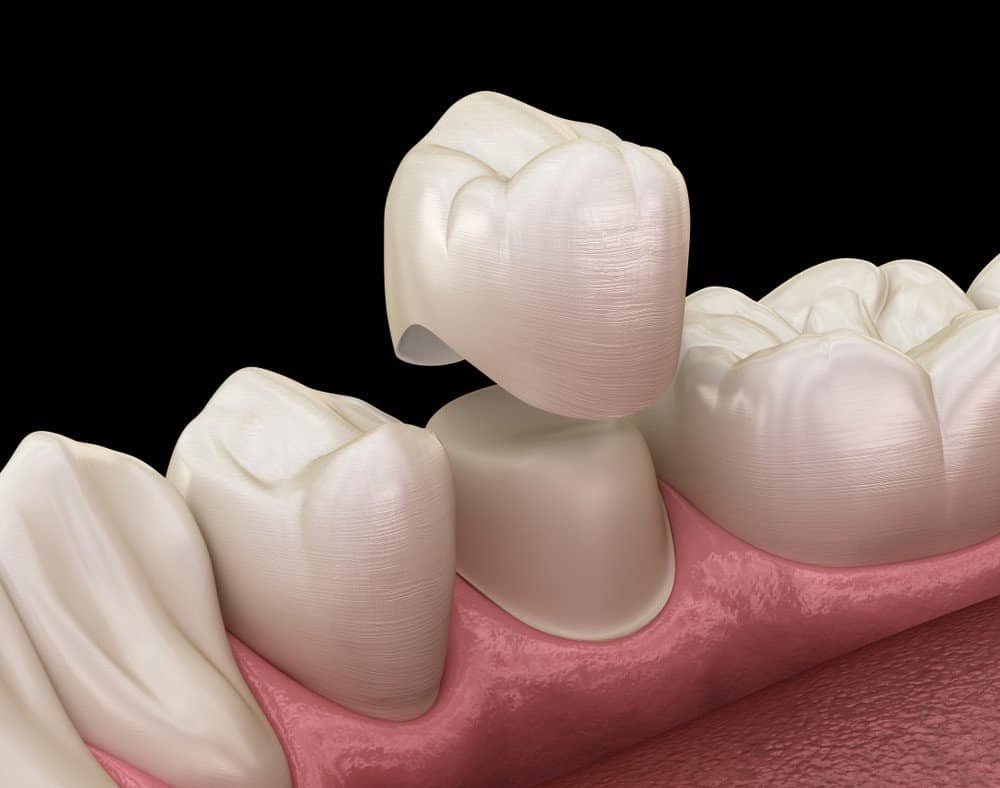 How Can You Prevent Common Dental Crown Problems Henley?