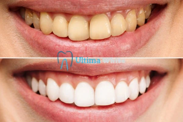 Oral Care Tips for Current and Former Smokers Henley