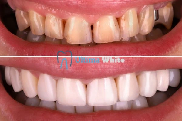 What Makes Instant Teeth Whitening Treatments So Popular Henley?