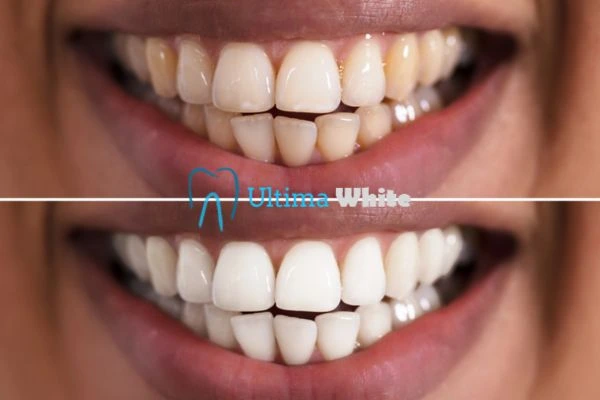 Aftercare Tips to Maintain Your New Smile Henley